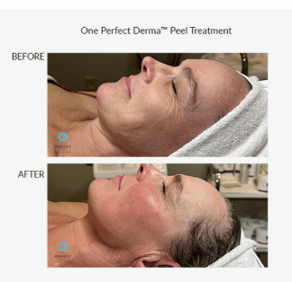 screenshot_theperfectdermapeel.com face.png