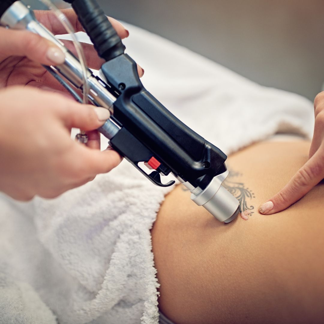 woman with tattoo removal 