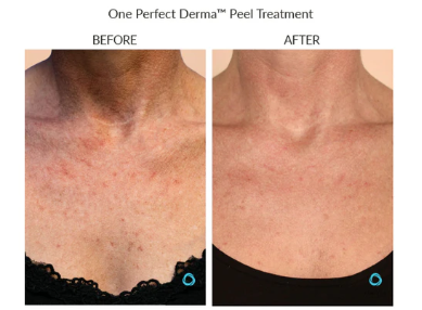 screenshot_theperfectdermapeel.com chest.png