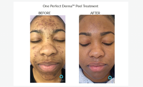 screenshot_theperfectdermapeel.com malen.png