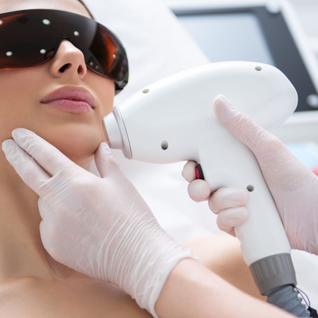 laser hair removal