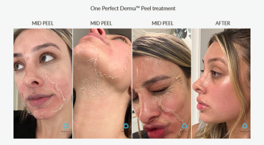 screenshot_theperfectdermapeel.com peel.png