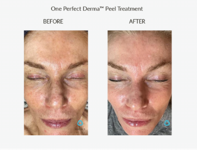 screenshot_theperfectdermapeel.com face2.png