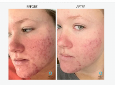 screenshot_theperfectdermapeel.com acne.png