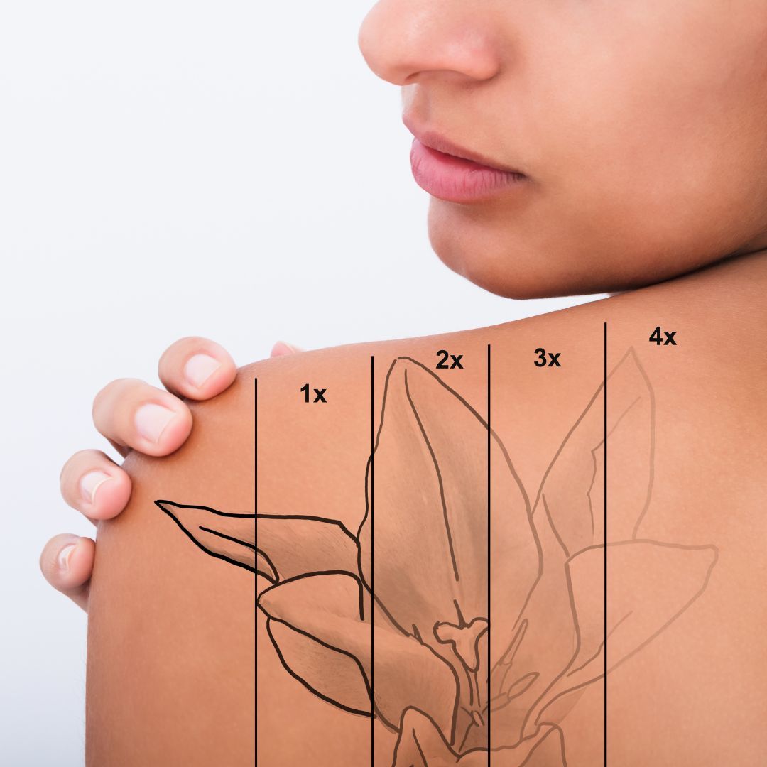 approximate example of tattoo removal stages