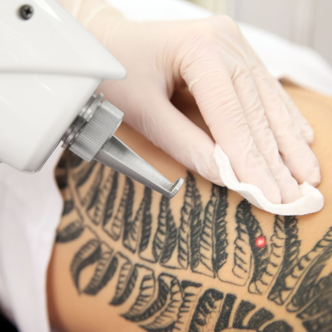 laser tattoo removal