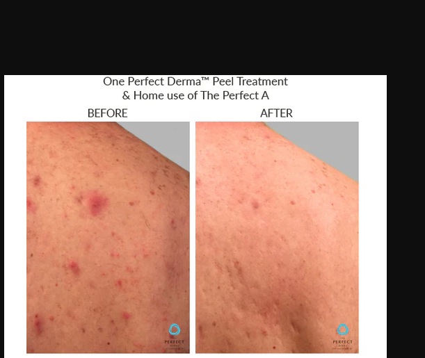 screenshot_theperfectdermapeel.com back.png