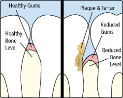 periodontitis-170209-589c94928194b.gif