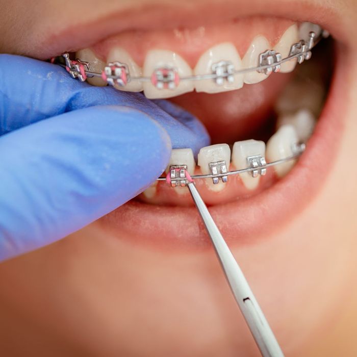 Rubber bands being applied to braces