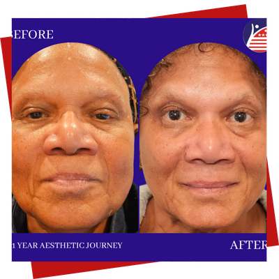 A before & after picture of a patient's face one year after medical-grade skincare treatment.