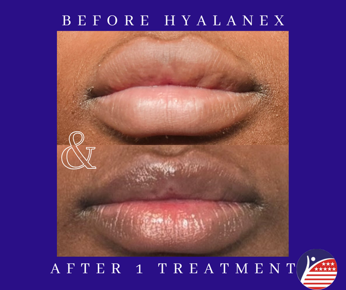 before and after images of lip fillers 