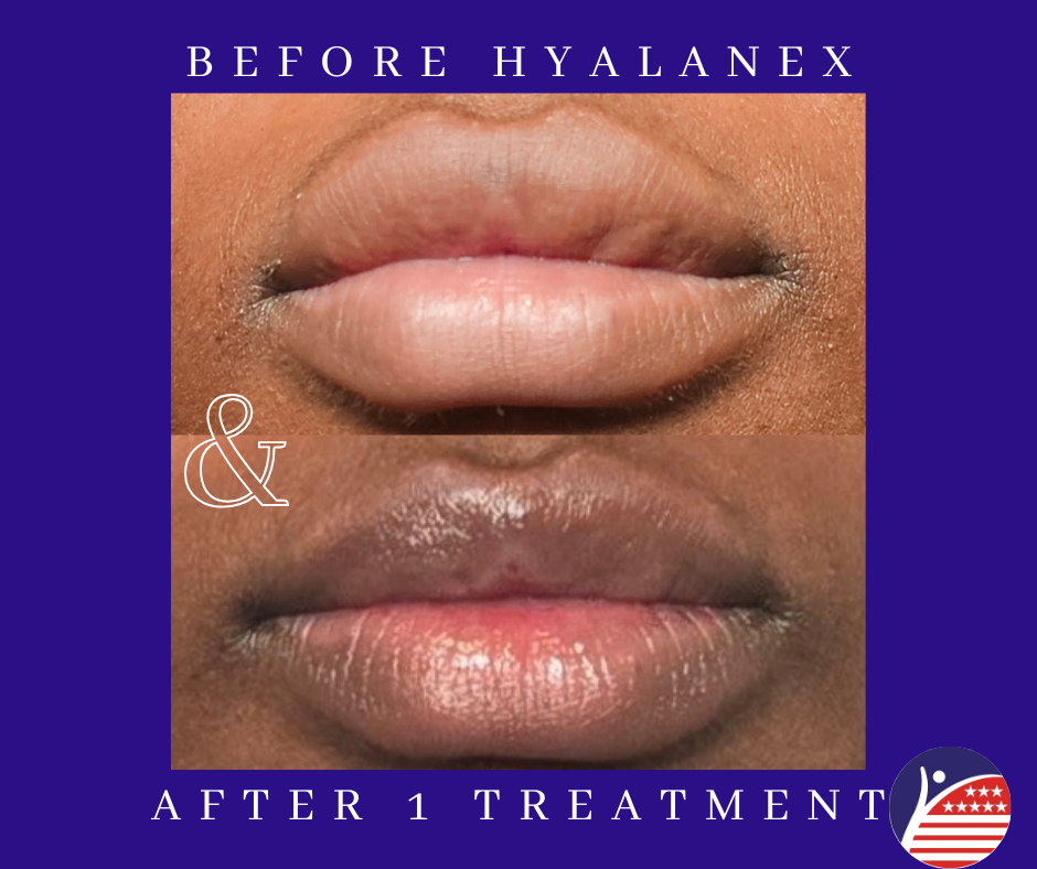before and after images of lip fillers 