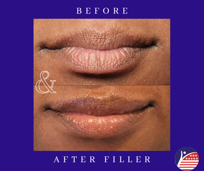 before and after images of lip fillers 