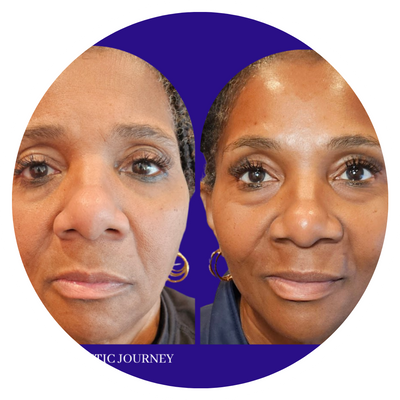 A before & after picture of a patient's face one year after medical-grade skincare treatment.