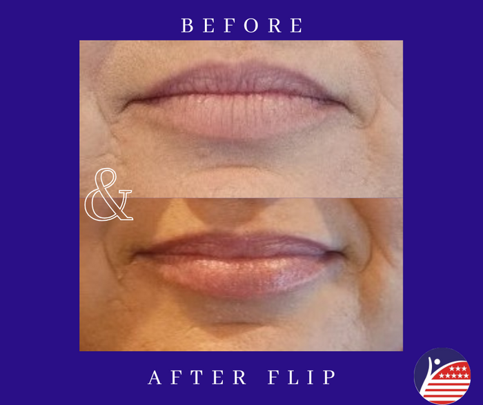 before and after images of lip fillers 