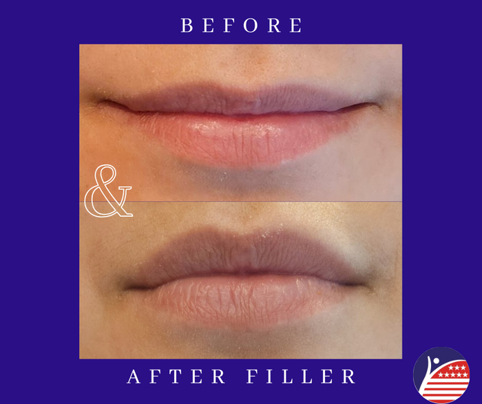 before and after images of lip fillers 