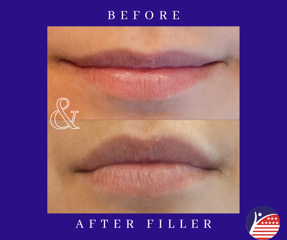 before and after images of lip fillers 
