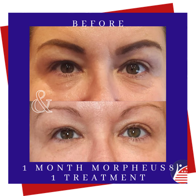 A before & after close-up of a woman's eyes from treatment, with tighter, smoother skin.