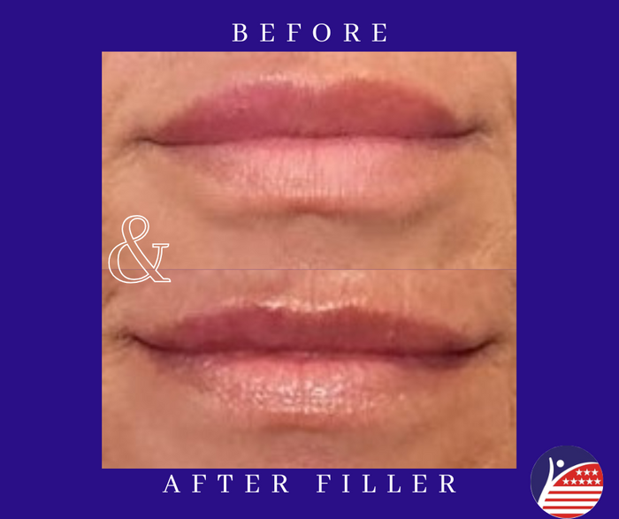 before and after images of lip fillers 