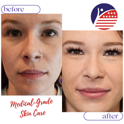 A before & after picture of a patient's face one year after medical-grade skincare treatment.