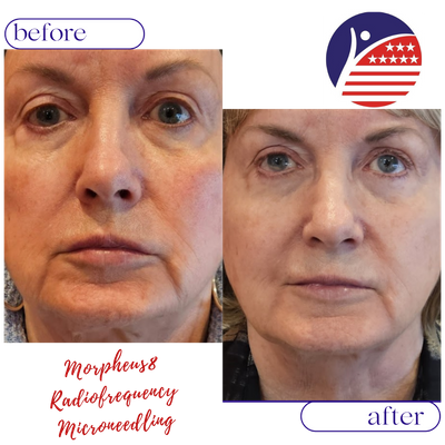 A before & after of a patient's face from Morpheus8, clearer and smoother skin.