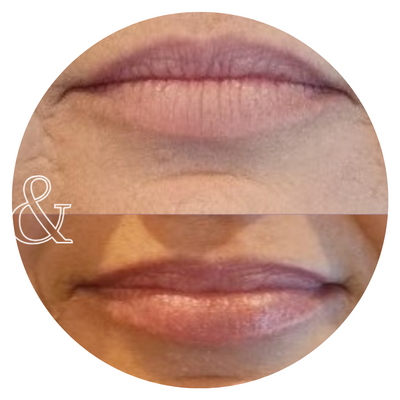A before & after of a woman's fuller lips after treatment.