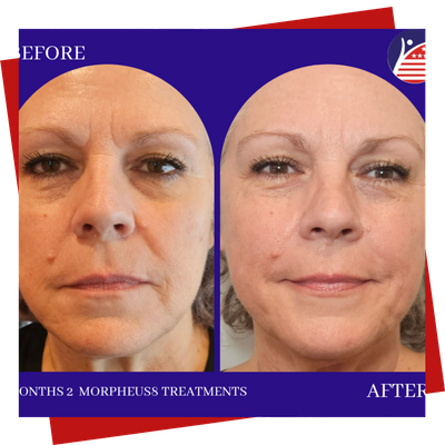 A before & after of a patient's face after two months of treatment, showing clearer, tighter skin.