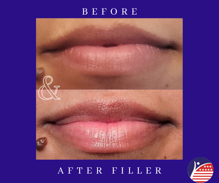 before and after images of lip fillers 