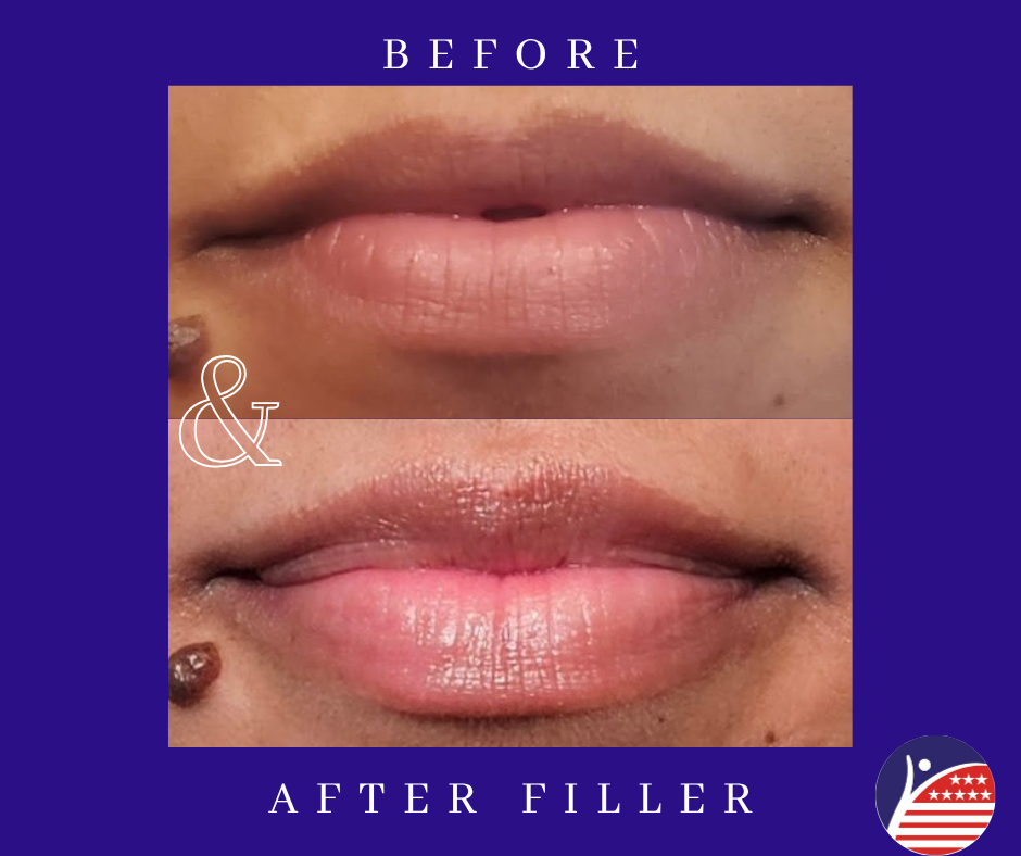 before and after images of lip fillers 