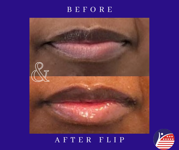before and after images of lip fillers 