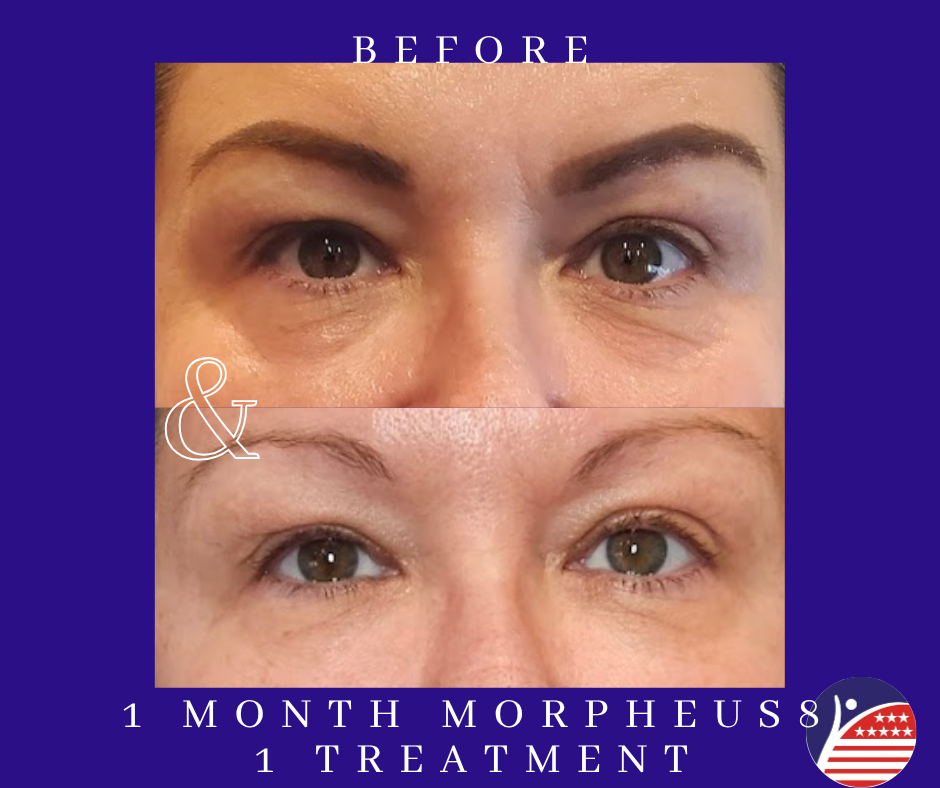 1 month of morpheus8 treatment 