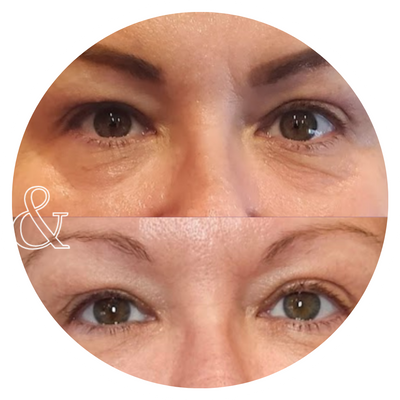 A before & after close-up of a woman's eyes from treatment, with tighter, smoother skin.