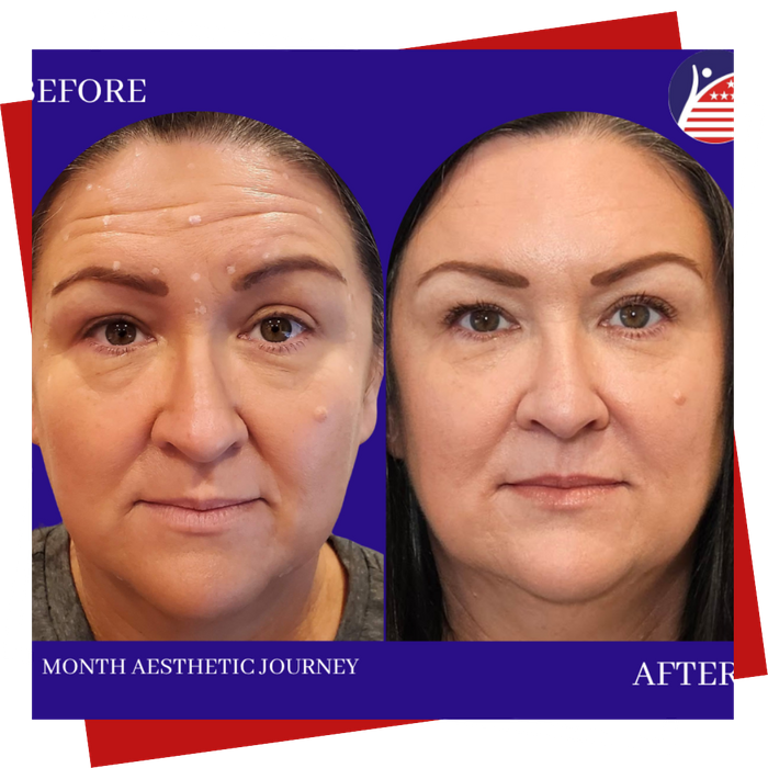 A before & after of a woman's face, one month into neurotoxin injections.