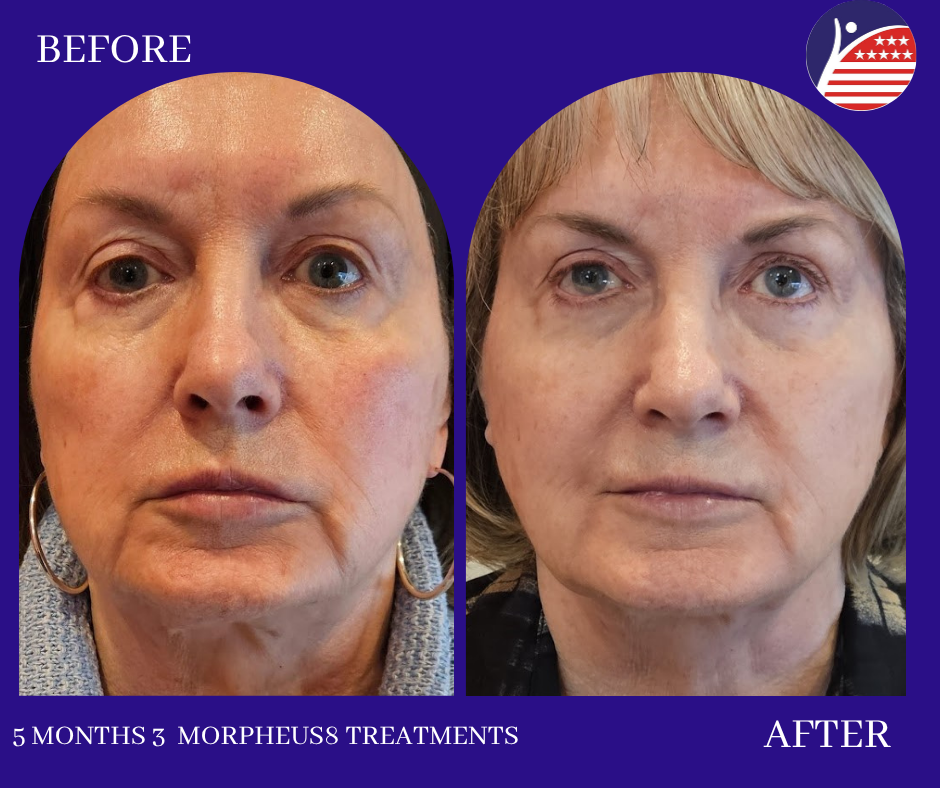 5 months of morpheus8 treatments 