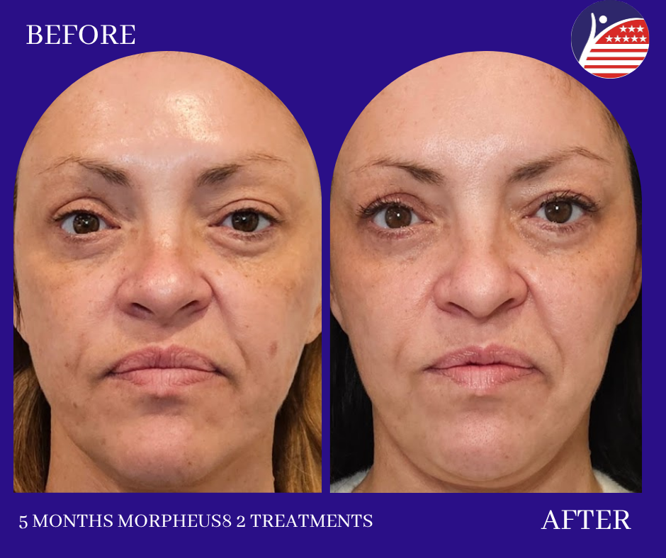 5 months of morpheus8 treatments 