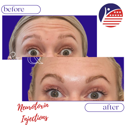 A before & after close-up of a woman forehead line disapearing after treatment.