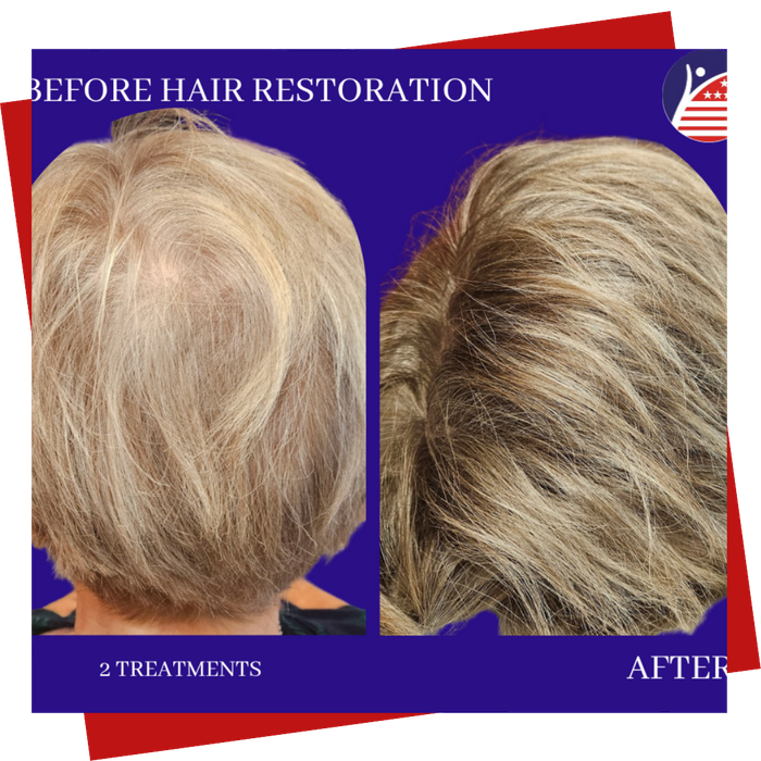 A before & after of a patient's hair after two treatments, showing fuller hair.