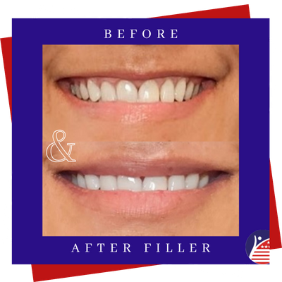 A before & after of a woman's fuller lips after treatment.