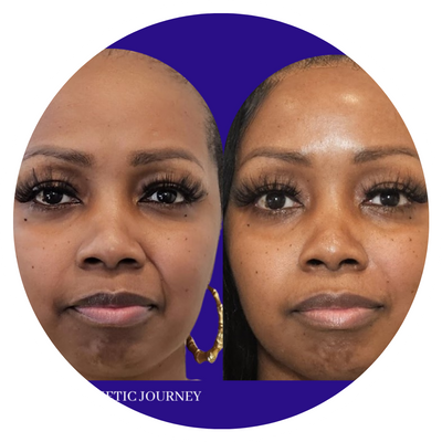 A before and after of a woman's face after treatment.