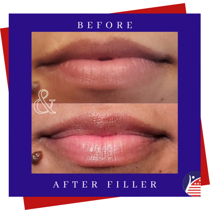 A before & after of a woman's fuller lips after treatment.