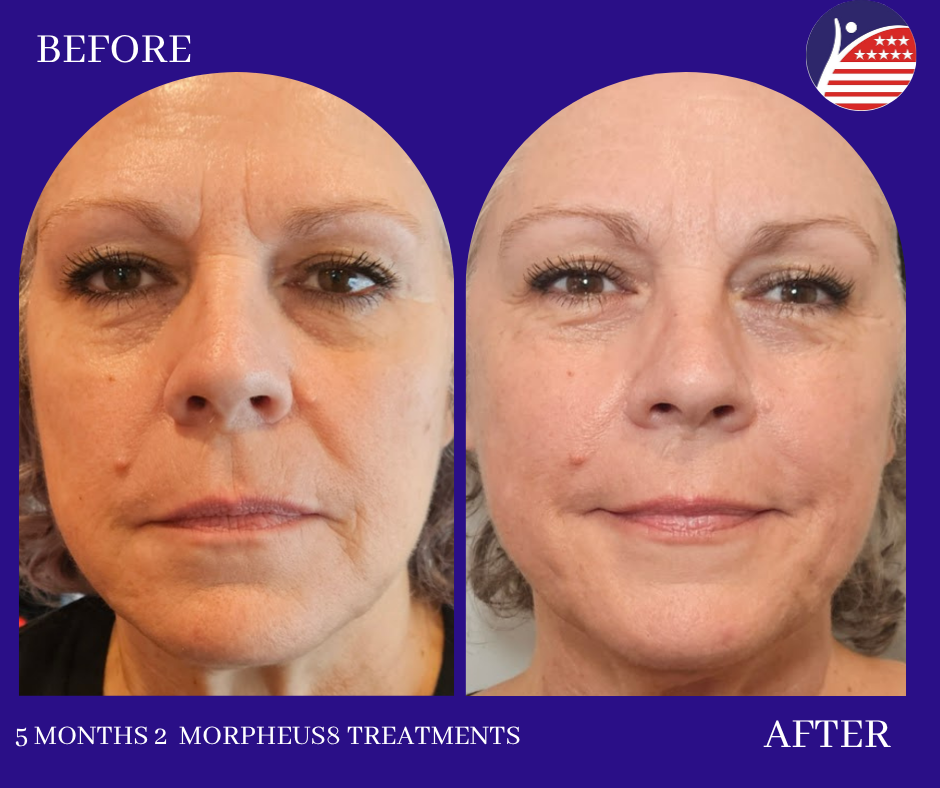 5 months of morpheus8 treatments 