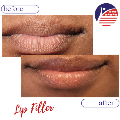 A before & after of a woman's fuller lips after treatment.