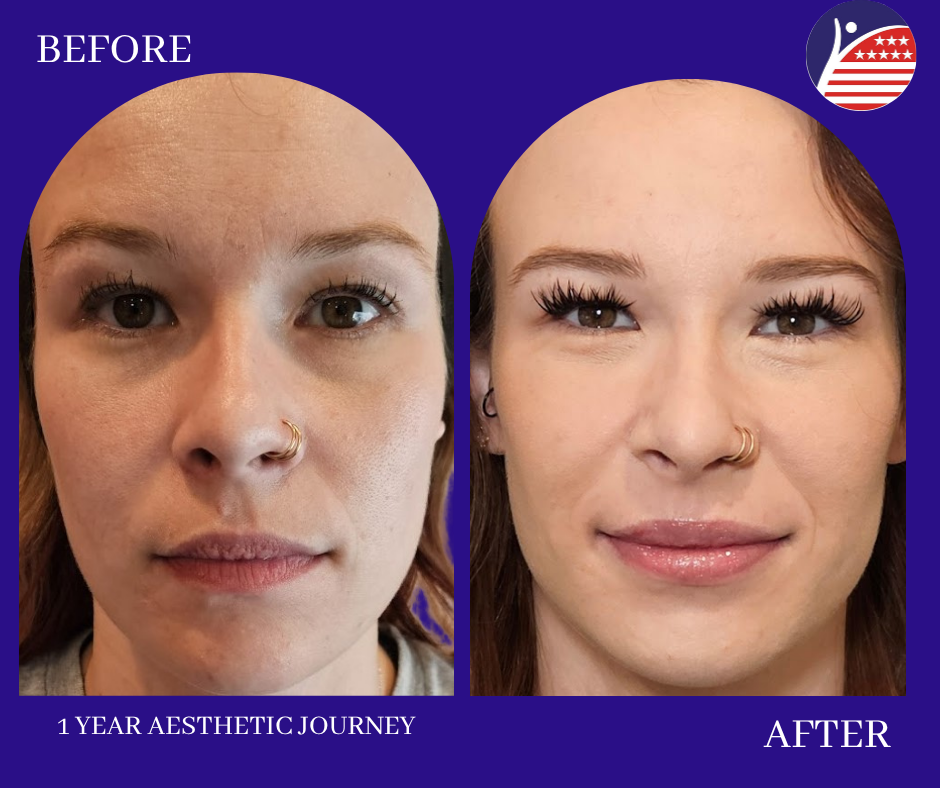 before and after 1 year 