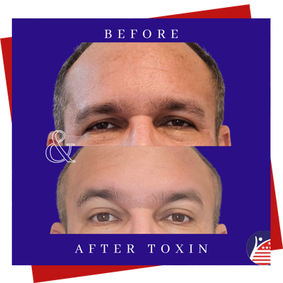 A close-up of a man's disappearing fine lines after treatment.