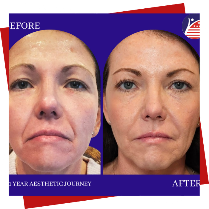 A before & after picture of a patient's face one year after medical-grade skincare treatment.