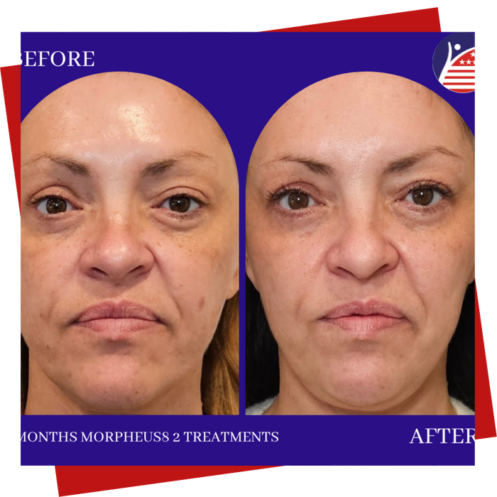A women with clearer skin and reduced fine lines from Morpheus8 after 2 treatments.