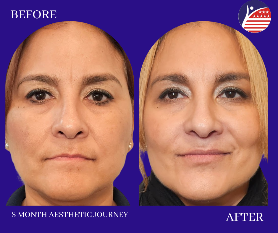 before and after 8 months 