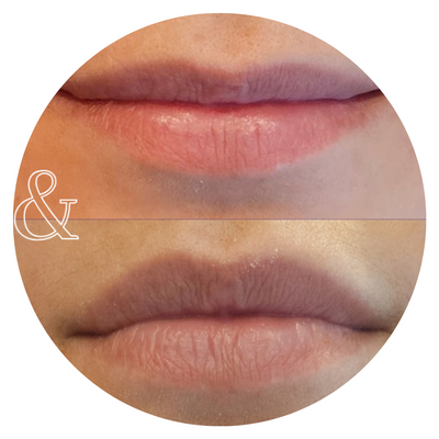 A before & after of a woman's fuller lips after treatment.