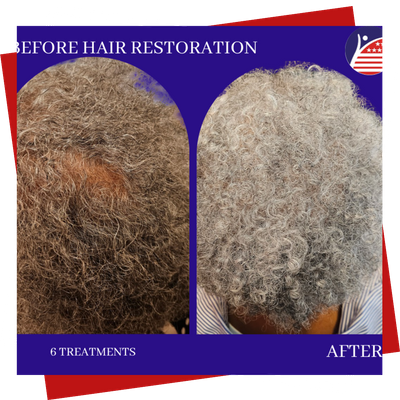 A before & after of a patient's hair after two treatments, showing fuller, healthier hair.