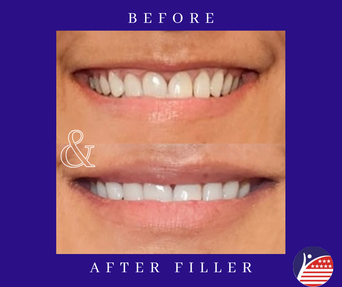 before and after images of lip fillers 